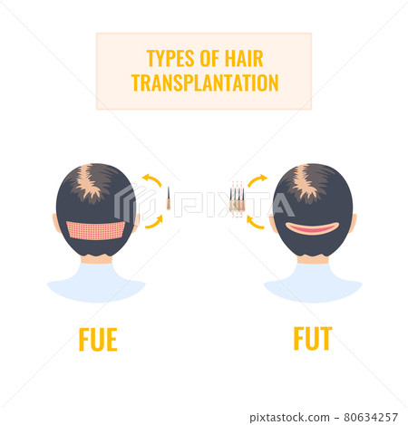 Female hair transplantation infographics of FUT and FUE methods Female hair transplantation infographics of FUT and FUE methods 80634257