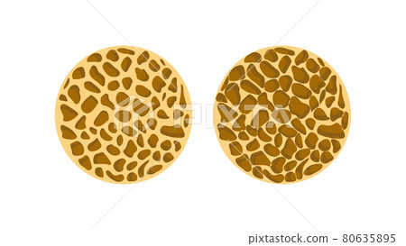 bone spongy structure, normal and with osteoporosis 80635895