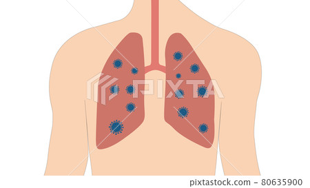 Corona Virus or Covid-19 in Human in Respiratory system and lungs Corona Virus or Covid-19 in Human in Respiratory system and lungs 80635900