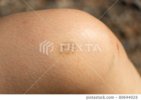 Background of bruised wound on wound woman at knee skin Background of bruised wound on wound woman at knee skin 80644028