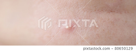 White red pimple on skin of face 80650129