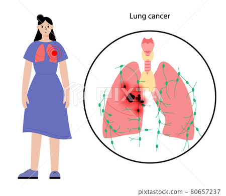 Lungs cancer disease 80657237
