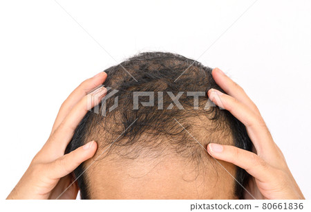 Close up of Male-pattern baldness with white copy-space, typically appears first at the hairline or top of the head. It can progress to partial or complete baldness. Close up of Male-pattern baldness with white copy-space, typically appears first at the hairline or top of the head. It can progress to partial or complete baldness. 80661836