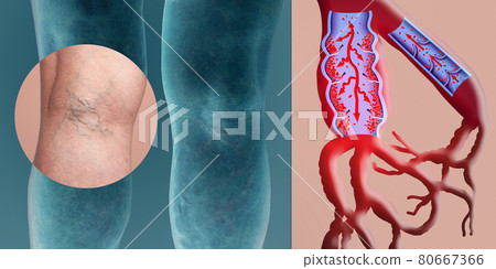 Varicose veins on a female senior legs. The structure of normal and varicose veins. Varicose veins on a female senior legs. The structure of normal and varicose veins. 80667366