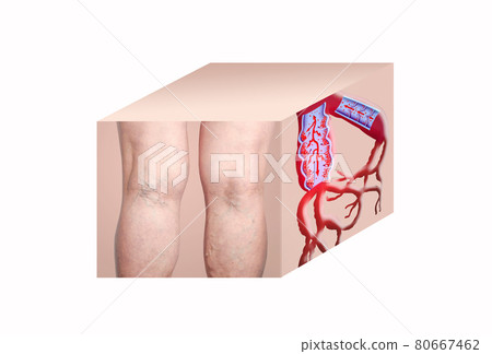Varicose veins on a female senior legs. The structure of normal and varicose veins. 80667462
