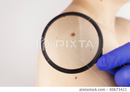 A man at a dermatologist appointment shows his birthmarks, moles and nevi. The doctor examines the patient with a dermatoscope. Benign and malignant birthmarks. Skin abnormalities care concept A man at a dermatologist appointment shows his birthmarks, moles and nevi. The doctor examines the patient with a dermatoscope. Benign and malignant birthmarks. Skin abnormalities care concept 80673421