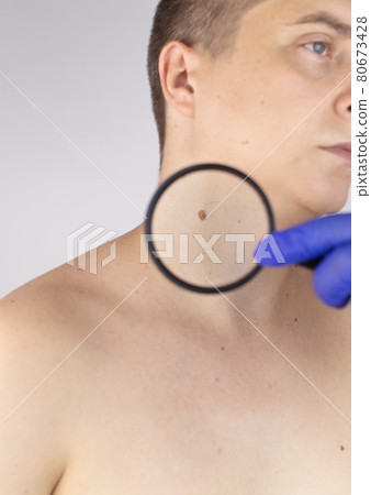 A man at a dermatologist appointment shows his birthmarks, moles and nevi. The doctor examines the patient with a dermatoscope. Benign and malignant birthmarks. Skin abnormalities care concept A man at a dermatologist appointment shows his birthmarks, moles and nevi. The doctor examines the patient with a dermatoscope. Benign and malignant birthmarks. Skin abnormalities care concept 80673428