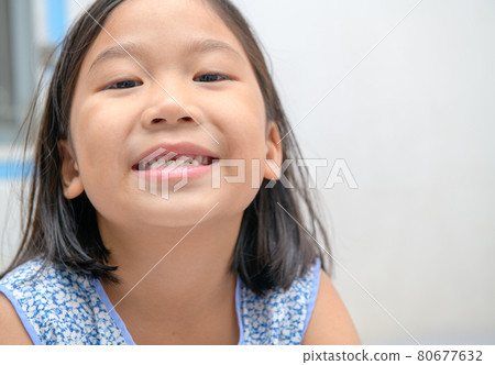 Asian kid girl smile and showing her broken milk teeth. Oral heath concept . 80677632