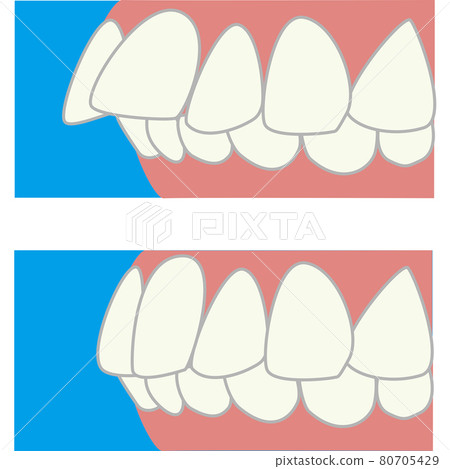 Twisting protruding side before and after tooth treatment Twisting protruding side before and after tooth treatment 80705429