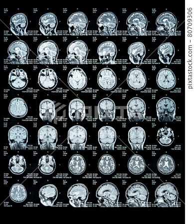 MRI Scan of a human brain showing all main multiple sclerosis details MRI Scan of a human brain showing all main multiple sclerosis details 80709306