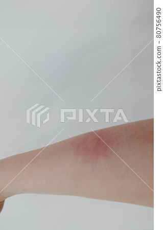 bitten by a mosquito bitten by a mosquito 80756490