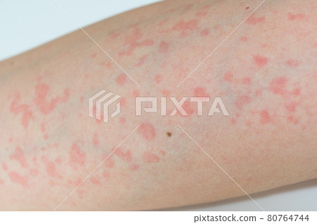 蕁麻疹的症狀 80764744