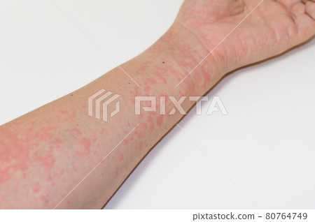Symptoms of urticaria 80764749