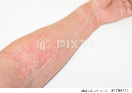 Symptoms of urticaria Symptoms of urticaria 80764751