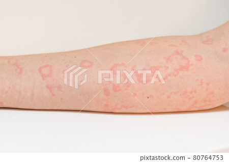 Symptoms of urticaria Symptoms of urticaria 80764753