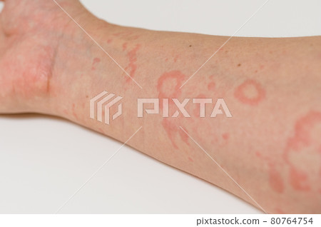 Symptoms of urticaria Symptoms of urticaria 80764754
