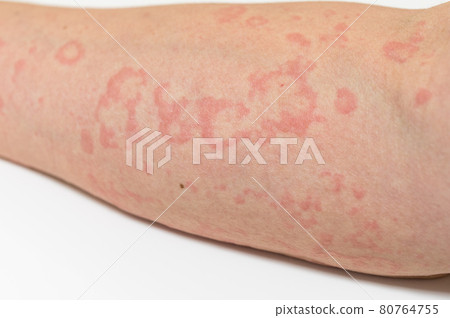 蕁麻疹的症狀 蕁麻疹的症狀 80764755