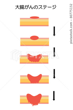 Illustration of colorectal cancer stage progression Illustration of colorectal cancer stage progression 80775132