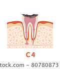 Dental caries illustration c4 that can be used for dentist's WEB production and graphic works 80780873