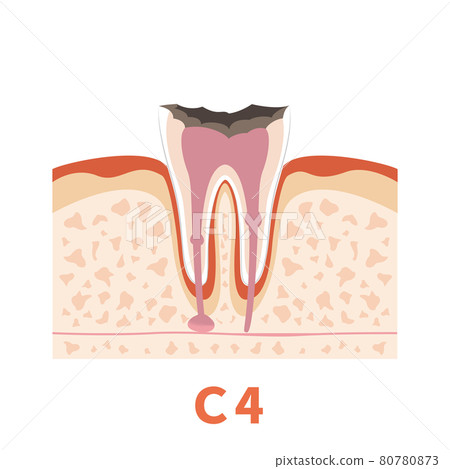 Dental caries illustration c4 that can be used for dentist's WEB production and graphic works 80780873