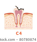 Dental caries illustration c4 that can be used for dentist's WEB production and graphic works 80780874