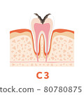 Dental caries illustration c3 that can be used for dentist's WEB production and graphic works 80780875