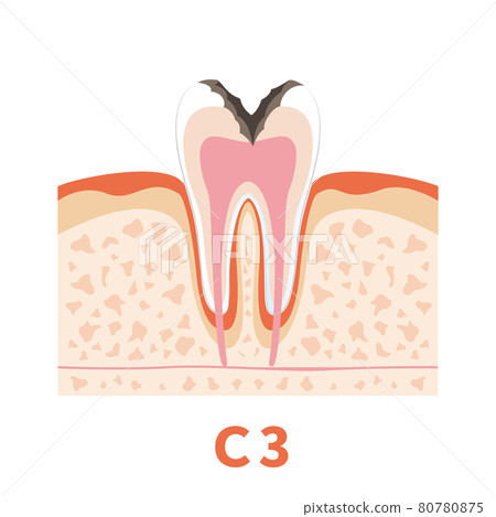 Dental caries illustration c3 that can be used for dentist's WEB production and graphic works 80780875