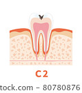 Dental caries illustration c2 that can be used for dentist's WEB production and graphic works 80780876