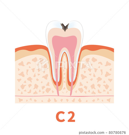 Dental caries illustration c2 that can be used for dentist's WEB production and graphic works 80780876