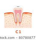 Dental caries illustration c1 that can be used for dentist's WEB production and graphic works 80780877