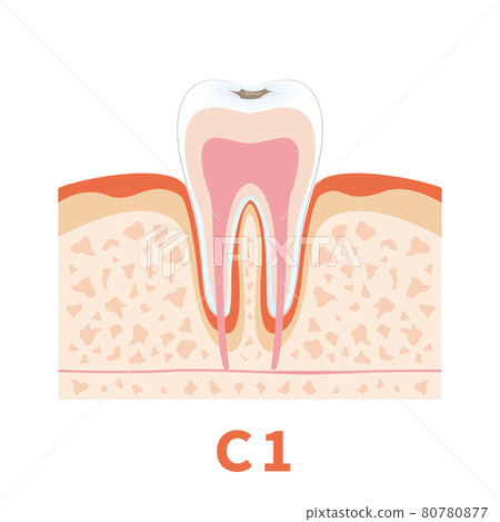 Dental caries illustration c1 that can be used for dentist's WEB production and graphic works 80780877