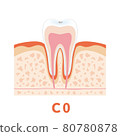 Dental caries illustration c0 that can be used for dentist's WEB production and graphic works 80780878