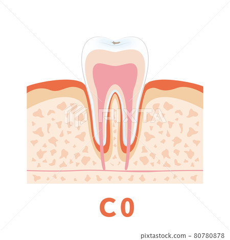 Dental caries illustration c0 that can be used for dentist's WEB production and graphic works 80780878
