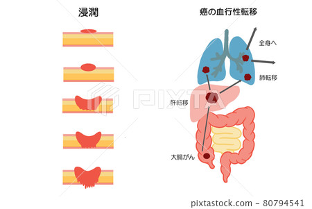 Illustration of colorectal cancer progression and metastasis 80794541
