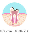Illustration of a dentist A picture of dental caries 80802514
