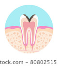 Illustration of a dentist A picture of dental caries 80802515