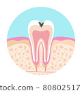 Illustration of a dentist A picture of dental caries 80802517