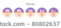 Illustration of dentist Dental caries picture set 80802637