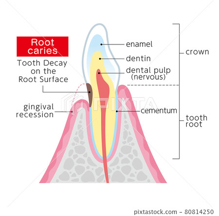 Root caries illustration illustration in English - Stock Illustration ...