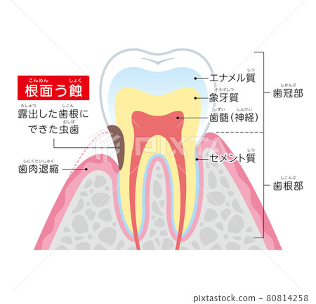 Root caries illustration illustration Root caries illustration illustration 80814258