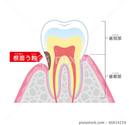Root caries illustration illustration Root caries illustration illustration 80814259