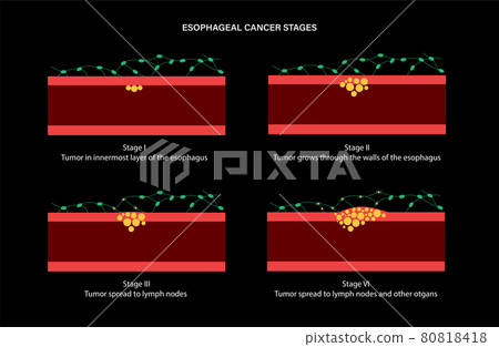 esophageal cancer stages esophageal cancer stages 80818418