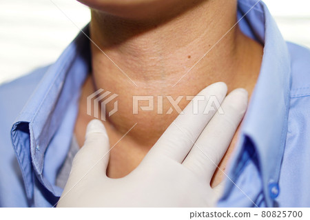 Asian lady woman patient have abnormal enlargement of thyroid gland Hyperthyroidism (overactive thyroid) at the throat : healthy strong medical concept . Asian lady woman patient have abnormal enlargement of thyroid gland Hyperthyroidism (overactive thyroid) at the throat : healthy strong medical concept . 80825700