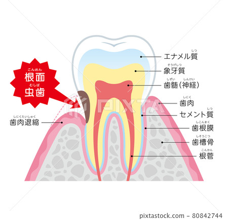 根齲圖解說明 80842744