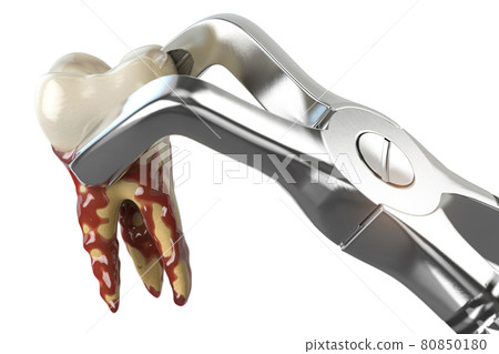 Tooth extraction with dental forceps isolated on white background. 3d illustration Tooth extraction with dental forceps isolated on white background. 3d illustration 80850180