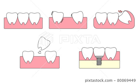 Illustration of gingival teeth. Healthy teeth, wobbling teeth, missing teeth, implants. 80869449