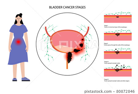 Bladder cancer stages 80872846
