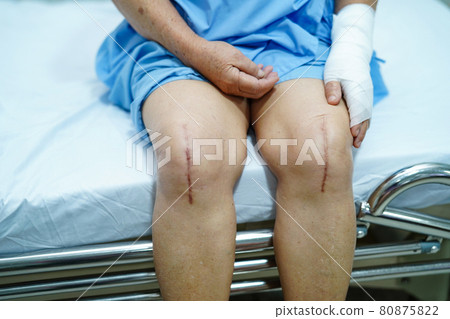 Asian senior or elderly old lady woman patient show her scars surgical total knee joint replacement Suture wound surgery arthroplasty on bed in nursing hospital ward : healthy strong medical concept.. Asian senior or elderly old lady woman patient show her scars surgical total knee joint replacement Suture wound surgery arthroplasty on bed in nursing hospital ward : healthy strong medical concept.. 80875822