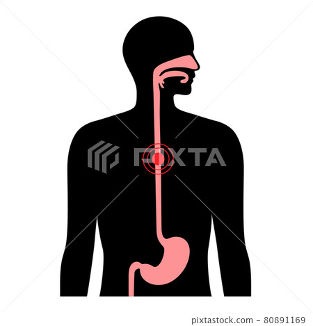 esophageal cancer concept 80891169