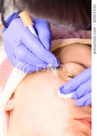 Miliums on the face, removal of hardened and mature milia by a beautician. 80901450